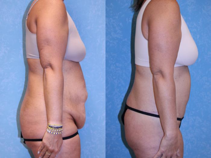 Before & After Body Lift Case 557 Right Side View in Toledo, Ohio