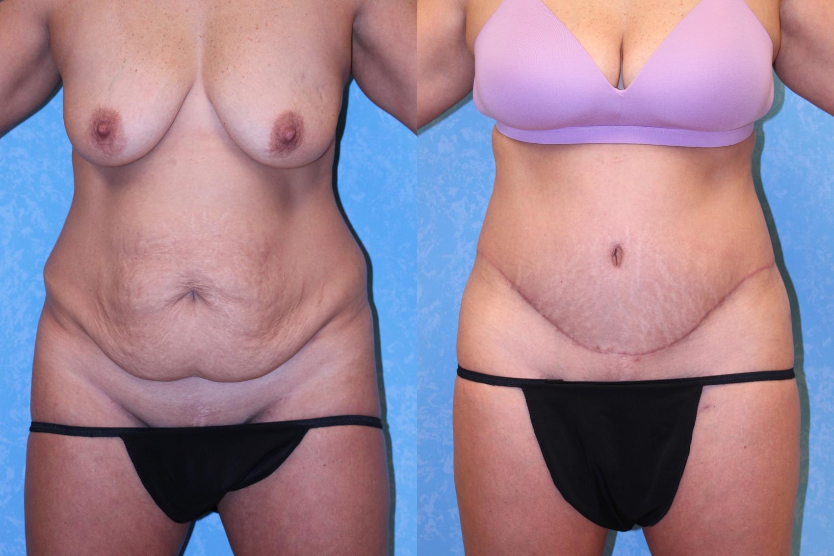 Before & After Body Lift Case 570 Front View in Toledo, Ohio