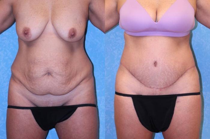 Before & After Body Lift Case 570 Front View in Toledo, Ohio