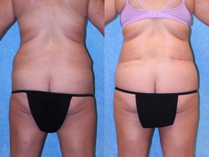 Before & After Body Lift Case 570 Left Oblique View in Toledo, Ohio