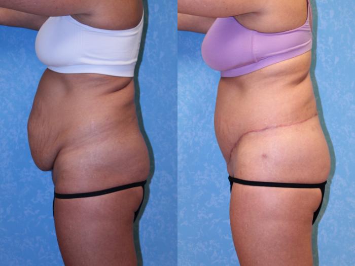 Before & After Body Lift Case 570 Left Side View in Toledo, Ohio