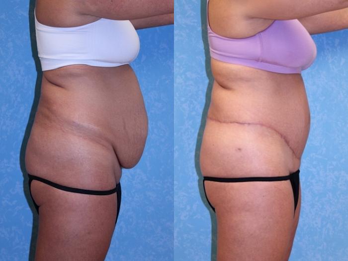 Before & After Body Lift Case 570 Right Side View in Toledo, Ohio