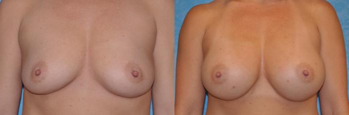 Before & After Breast Augmentation Case 133 View #1 View in Toledo, Ohio
