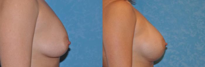 Before & After Breast Augmentation Case 133 View #2 View in Toledo, Ohio