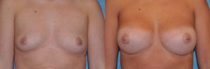 Before & After Breast Augmentation Case 134 View #1 View in Toledo, Ohio