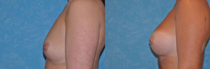 Before & After Breast Augmentation Case 134 View #2 View in Toledo, Ohio
