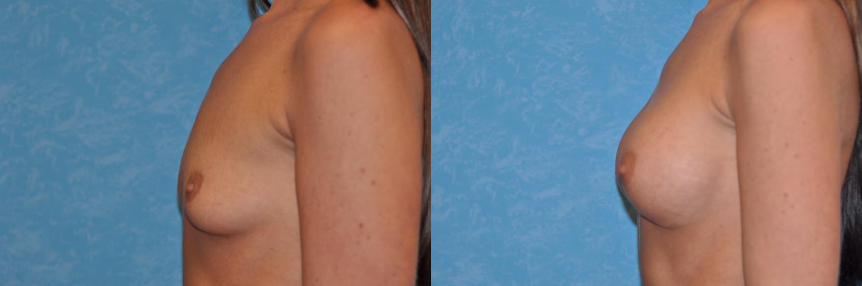 Before & After Breast Augmentation Case 135 View #1 View in Toledo, Ohio