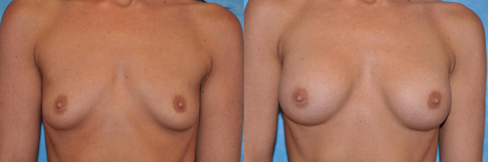 Before & After Breast Augmentation Case 135 View #2 View in Toledo, Ohio