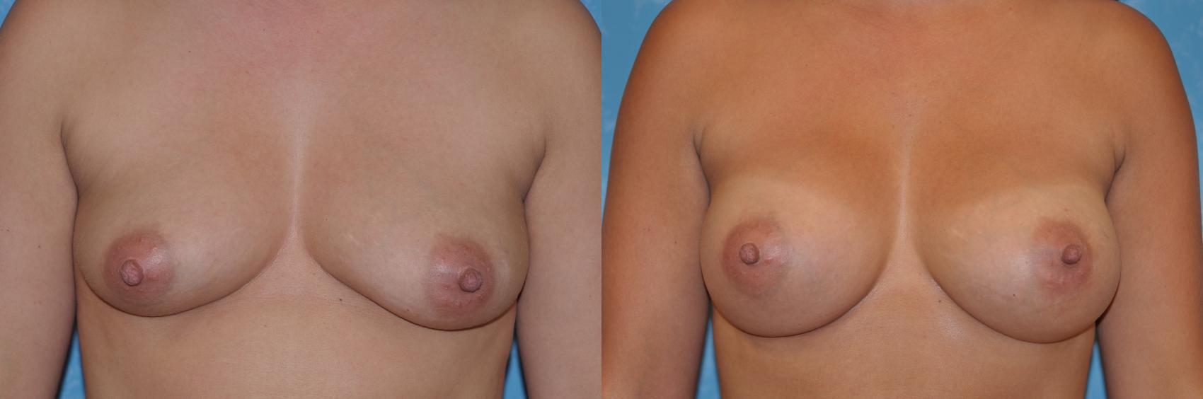 Before & After Breast Augmentation Case 137 View #1 View in Toledo, Ohio