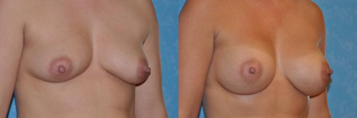 Before & After Breast Augmentation Case 137 View #2 View in Toledo, Ohio