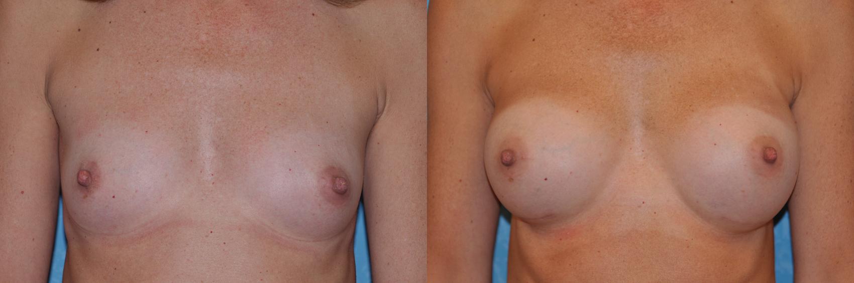 Before & After Breast Augmentation Case 148 View #1 View in Toledo, Ohio