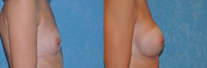 Before & After Breast Augmentation Case 148 View #2 View in Toledo, Ohio
