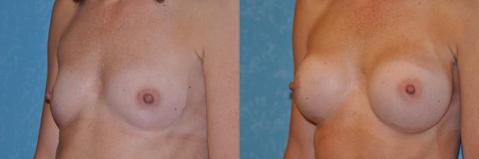 Before & After Breast Augmentation Case 148 View #3 View in Toledo, Ohio