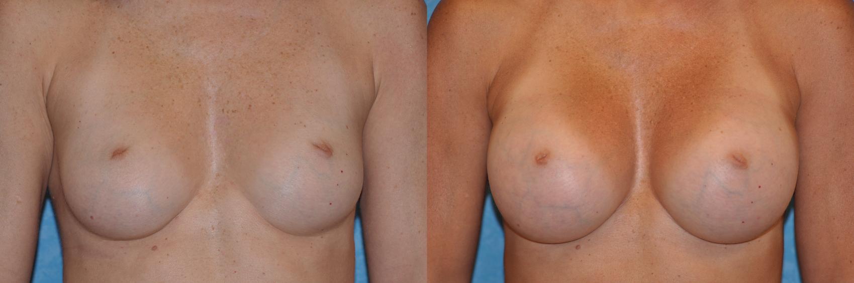 Before & After Breast Augmentation Case 152 Front View in Toledo, Ohio