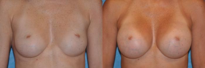 Before & After Breast Augmentation Case 152 Front View in Toledo, Ohio