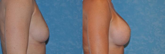 Before & After Breast Augmentation Case 152 Right Side View in Toledo, Ohio