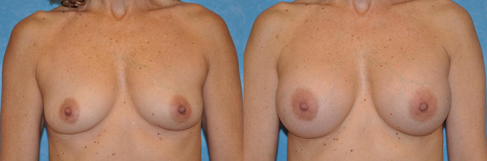 Before & After Breast Augmentation Case 187 View #1 View in Toledo, Ohio