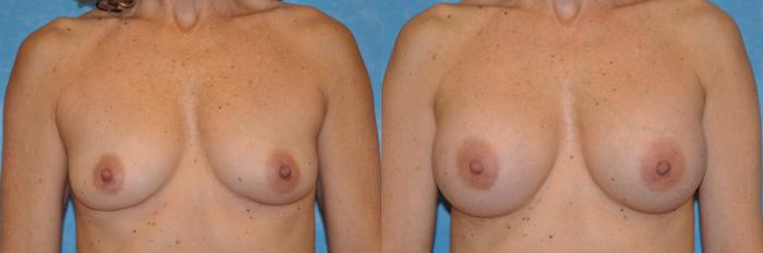 Before & After Breast Augmentation Case 187 View #1 View in Toledo, Ohio