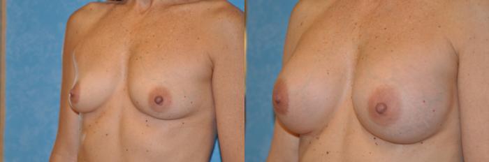 Before & After Breast Augmentation Case 187 View #2 View in Toledo, Ohio