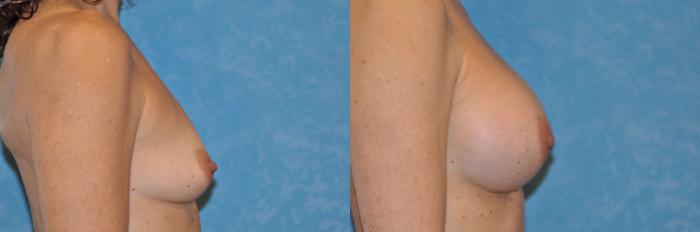 Before & After Breast Augmentation Case 187 View #3 View in Toledo, Ohio