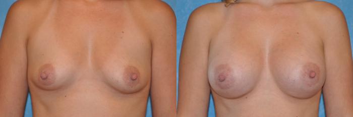 Before & After Breast Augmentation Case 189 View #1 View in Toledo, Ohio