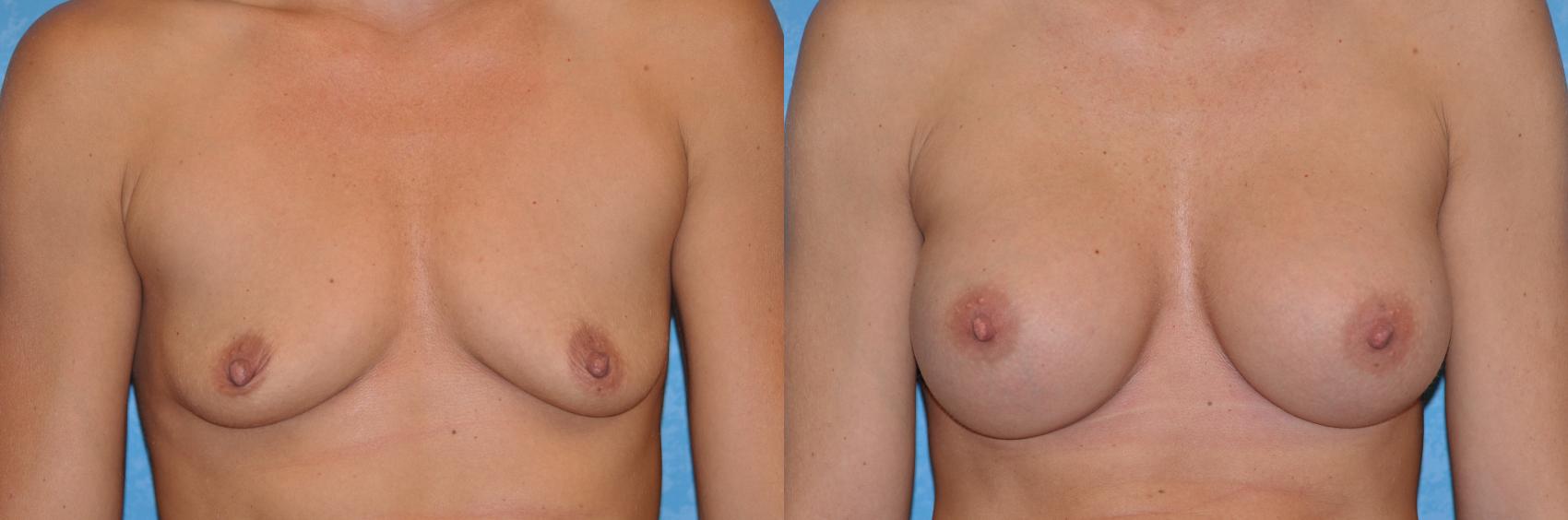 Before & After Breast Augmentation Case 192 View #1 View in Toledo, Ohio