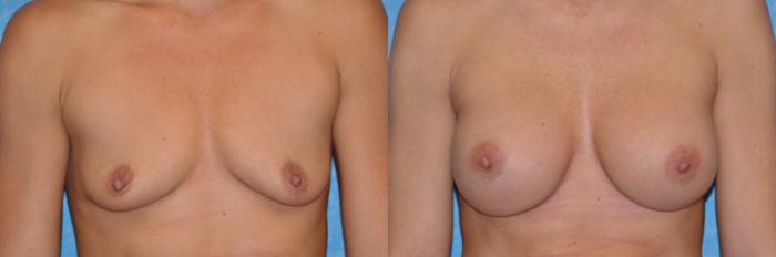 Before & After Breast Augmentation Case 192 View #1 View in Toledo, Ohio