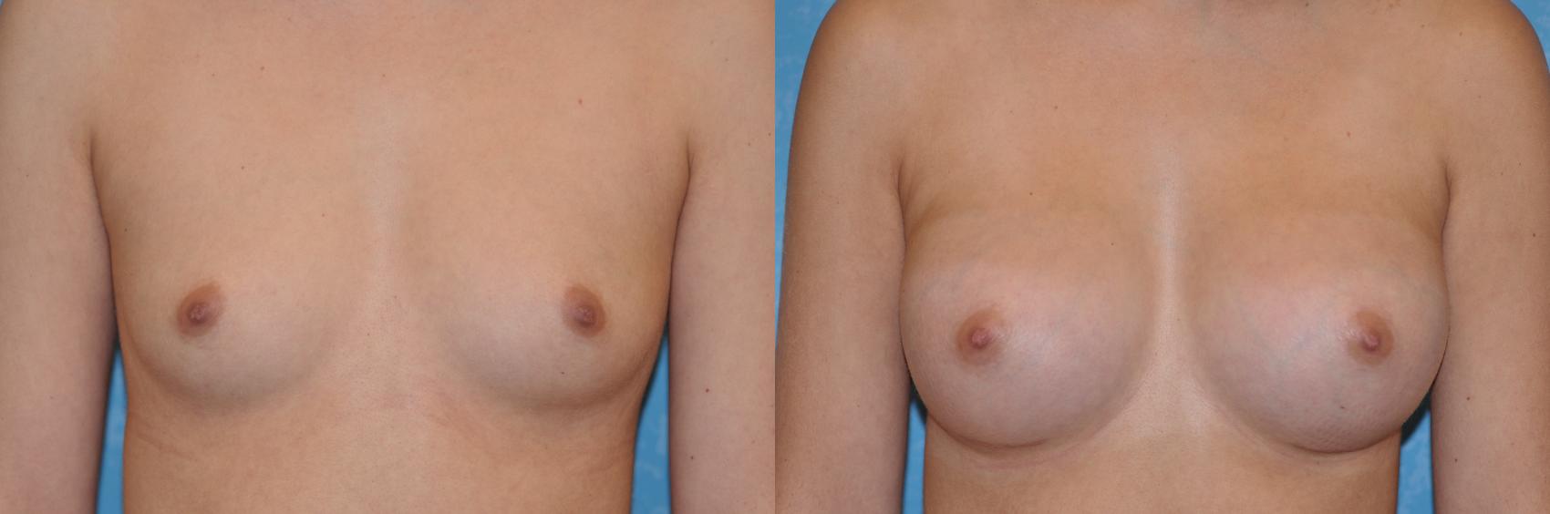 Before & After Breast Augmentation Case 194 View #1 View in Toledo, Ohio