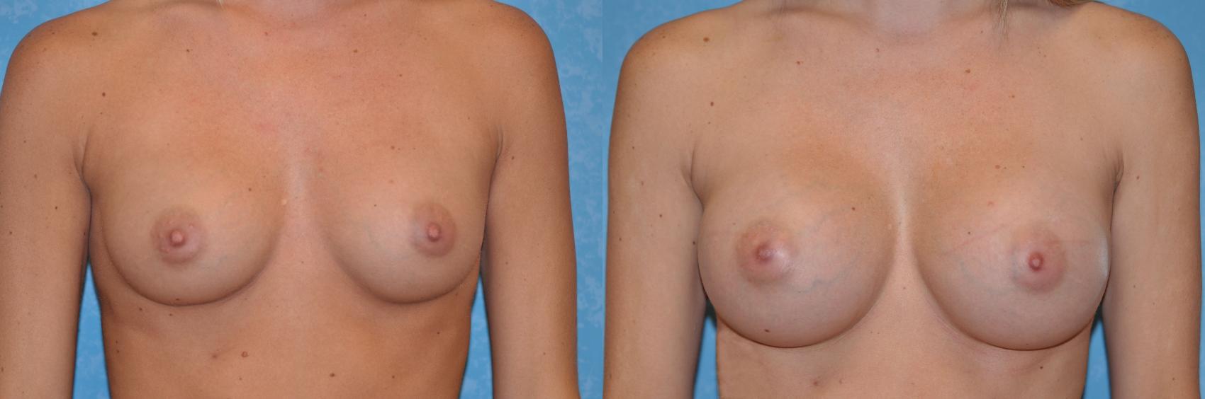 Before & After Breast Augmentation Case 196 View #1 View in Toledo, Ohio