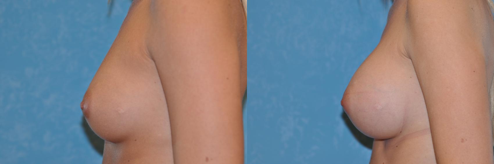 Before & After Breast Augmentation Case 196 View #2 View in Toledo, Ohio