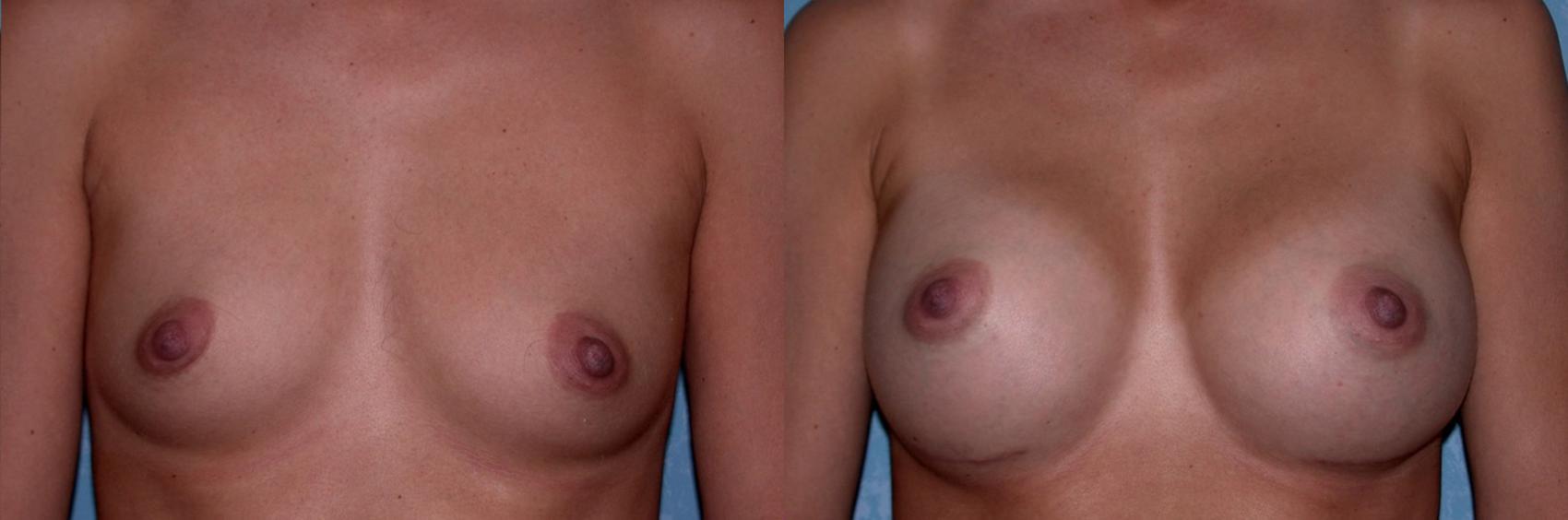 Before & After Breast Augmentation Case 20 View #1 View in Toledo, Ohio