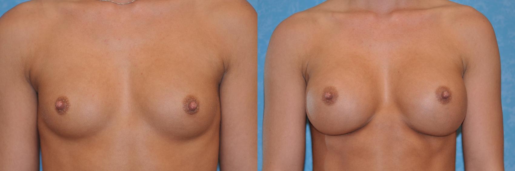 Before & After Breast Augmentation Case 200 View #1 View in Toledo, Ohio