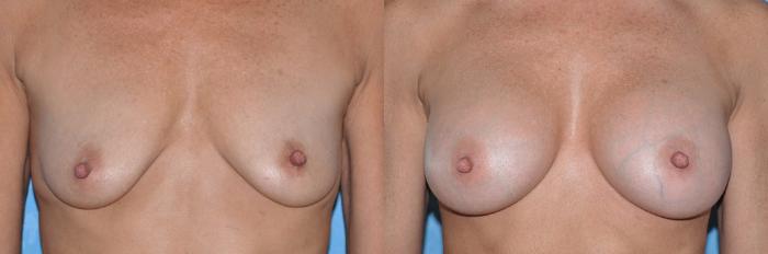 Before & After Breast Augmentation Case 21 View #1 View in Toledo, Ohio