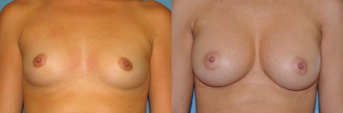 Before & After Breast Augmentation Case 22 View #1 View in Toledo, Ohio
