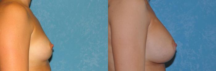 Before & After Breast Augmentation Case 22 View #2 View in Toledo, Ohio