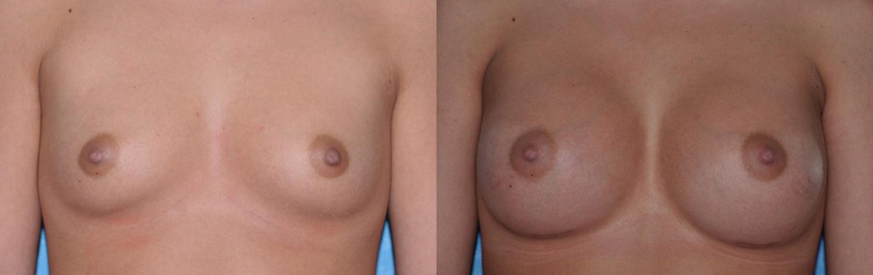 Before & After Breast Augmentation Case 23 View #1 View in Toledo, Ohio