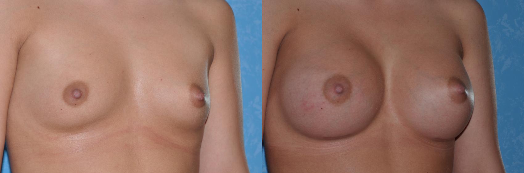 Before & After Breast Augmentation Case 23 View #3 View in Toledo, Ohio