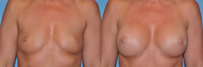 Before & After Breast Augmentation Case 231 View #1 View in Toledo, Ohio