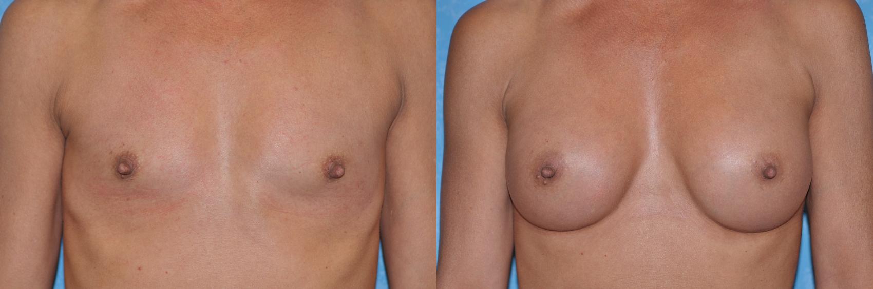 Before & After Breast Augmentation Case 232 View #1 View in Toledo, Ohio