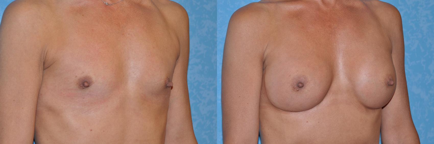 Before & After Breast Augmentation Case 232 View #3 View in Toledo, Ohio