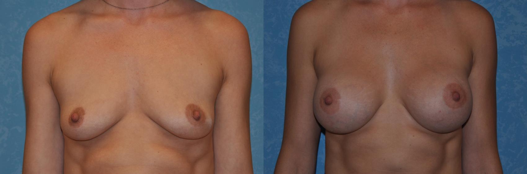 Before & After Breast Augmentation Case 234 View #1 View in Toledo, Ohio