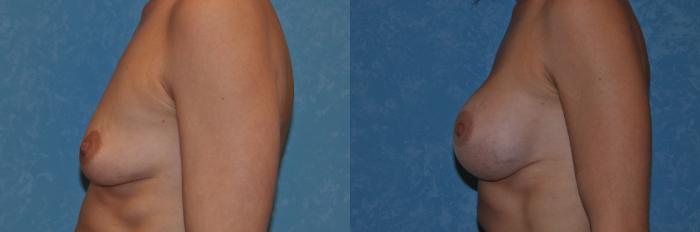 Before & After Breast Augmentation Case 234 View #2 View in Toledo, Ohio