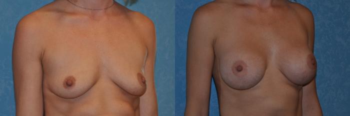 Before & After Breast Augmentation Case 234 View #3 View in Toledo, Ohio