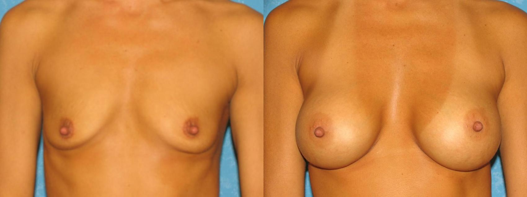Before & After Breast Augmentation Case 24 View #1 View in Toledo, Ohio