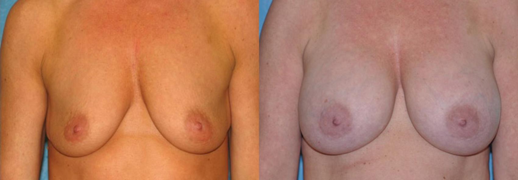 Before & After Breast Augmentation Case 25 View #1 View in Toledo, Ohio