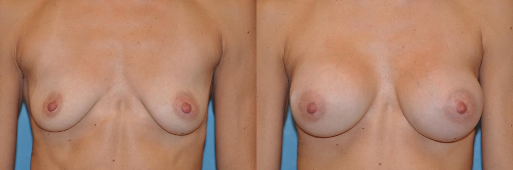 Before & After Breast Augmentation Case 255 View #1 View in Toledo, Ohio