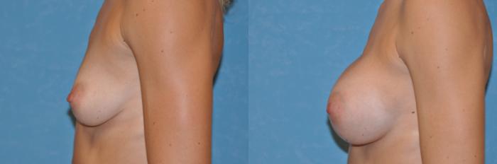 Before & After Breast Augmentation Case 255 View #2 View in Toledo, Ohio