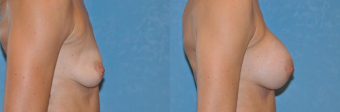 Before & After Breast Augmentation Case 255 View #3 View in Toledo, Ohio