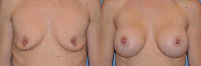 Before & After Breast Augmentation Case 257 View #1 View in Toledo, Ohio