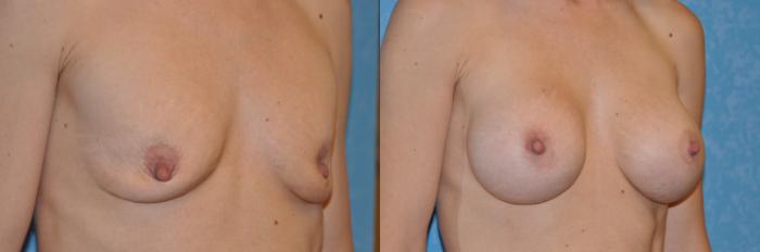Before & After Breast Augmentation Case 257 View #2 View in Toledo, Ohio